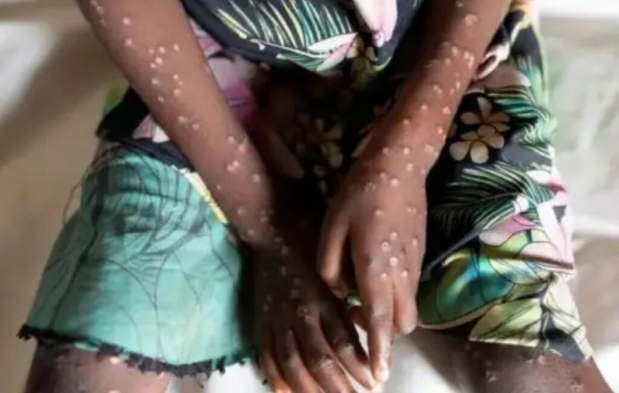 Mpox à Madagascar : 5 cas confirmés, une première pour la Grande Île