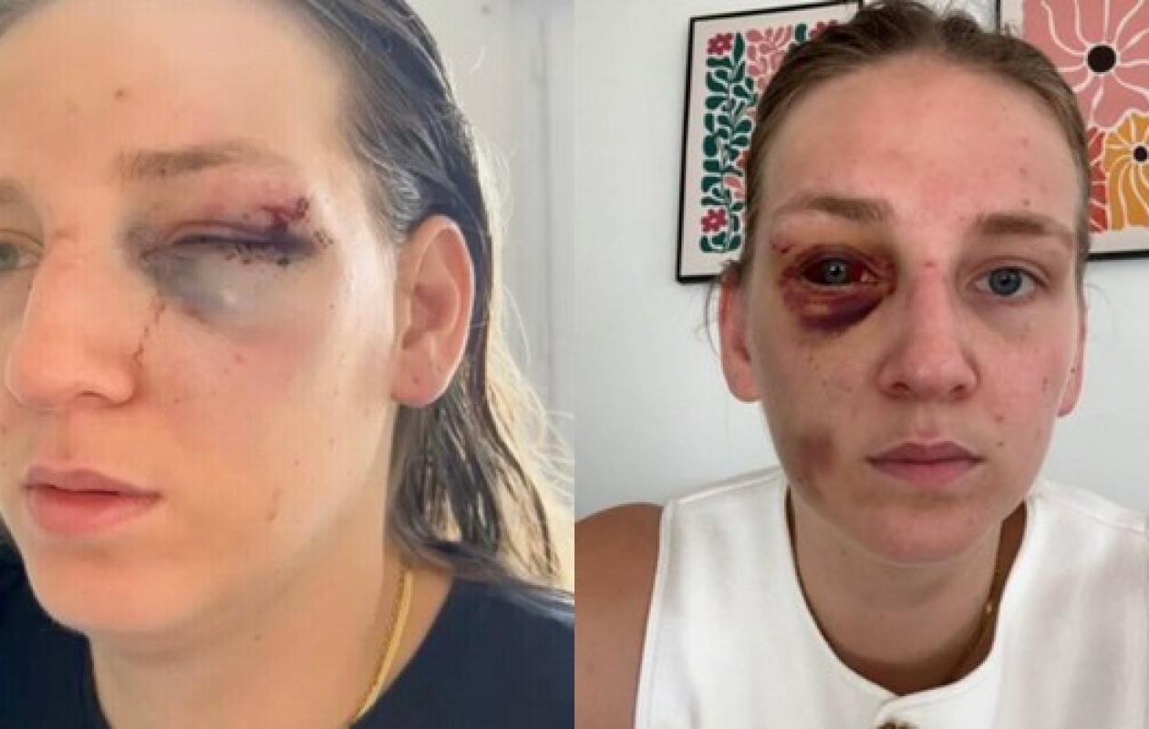 Manon, 27 ans, tabassée par un inconnu à la sortie d'une discothèque de Cherbourg