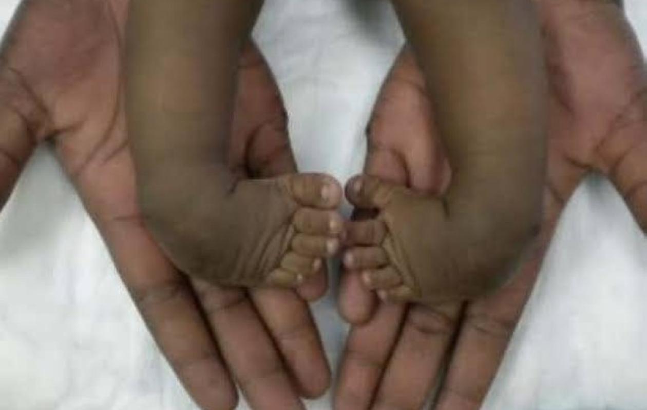 Soins du pied bot : 1 400 enfants pris en charge gratuitement en Côte d’Ivoire